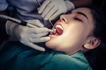Những thói quen không ngờ dễ gây sâu răng