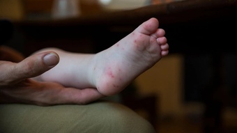 Sở Y tế Hà Nội cảnh báo cao điểm dịch tay chân miệng