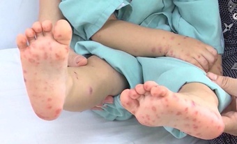 Nhiều bệnh truyền nhiễm gia tăng ở Đồng Nai