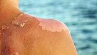 Cách chữa da cháy nắng sau khi tắm biển ngày hè