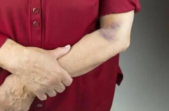 Bất kể nam hay nữ, nếu có hai triệu chứng ở cánh tay thì rất có thể là ung thư, nên đi khám và điều trị càng sớm càng tốt